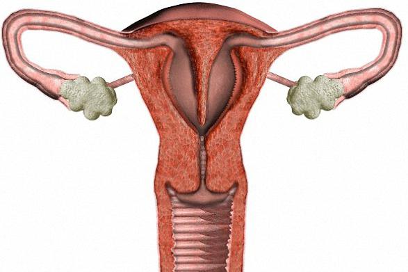 infiammazione delle appendici nei sintomi e nel trattamento delle donne