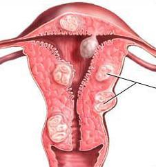 sintomi di infiammazione delle appendici nelle donne