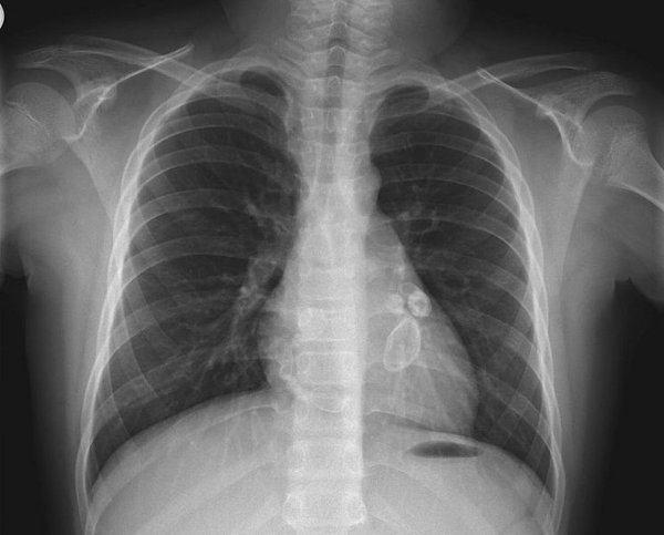 ki je boljša fluorografija ali rentgenska slika pljuč