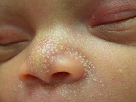 proč má novorozenec na obličeji bílé skvrny