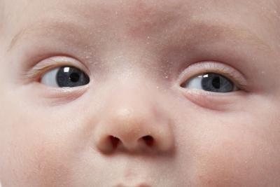 brufoli sul viso di un bambino