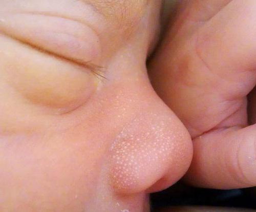 малки бели пъпки по лицето на новородено