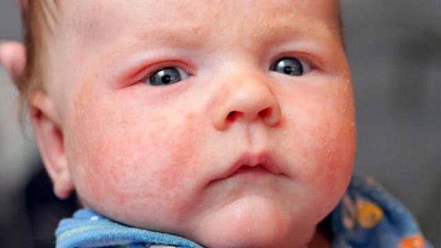 piccoli brufoli bianchi sul viso di un neonato