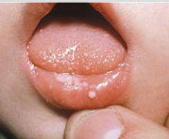 beli jezik na prsih