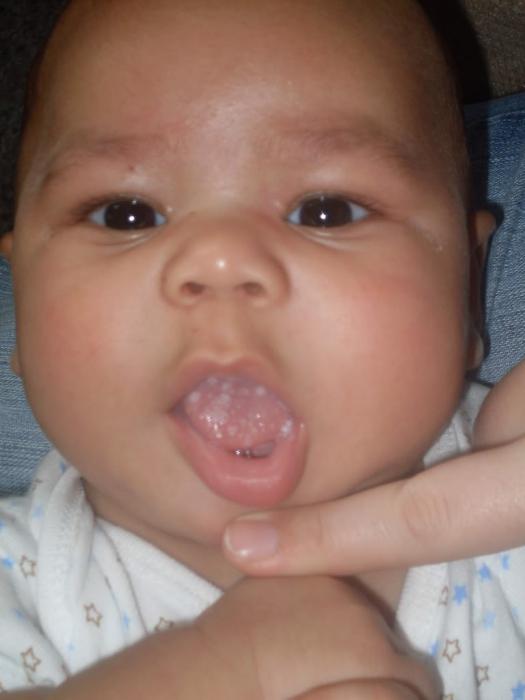 biała tablica na języku u niemowląt karmionych sztucznym pokarmem