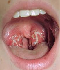 incursioni di tonsille senza temperatura