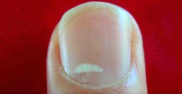 Macchie bianche sulla causa delle unghie