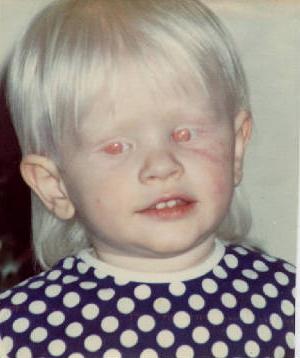 lidé s červenými očima albinos