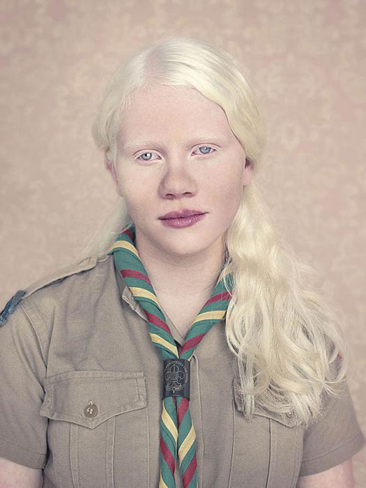 děti albínů
