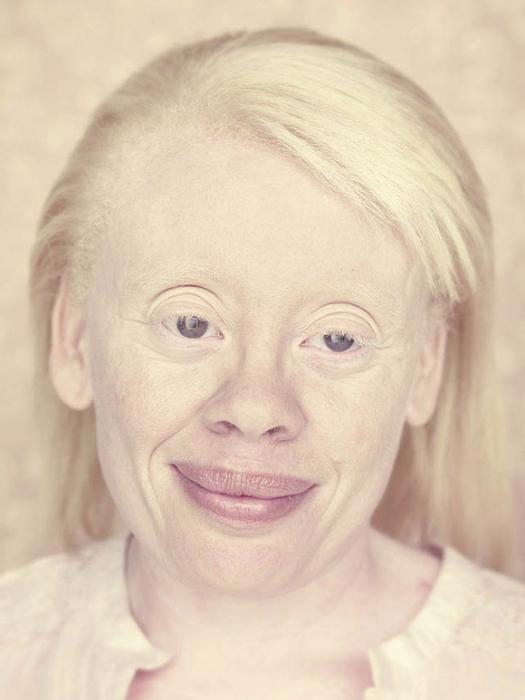 lidské albino oči