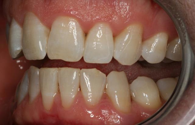 сви зуби су повређени одједном и десни