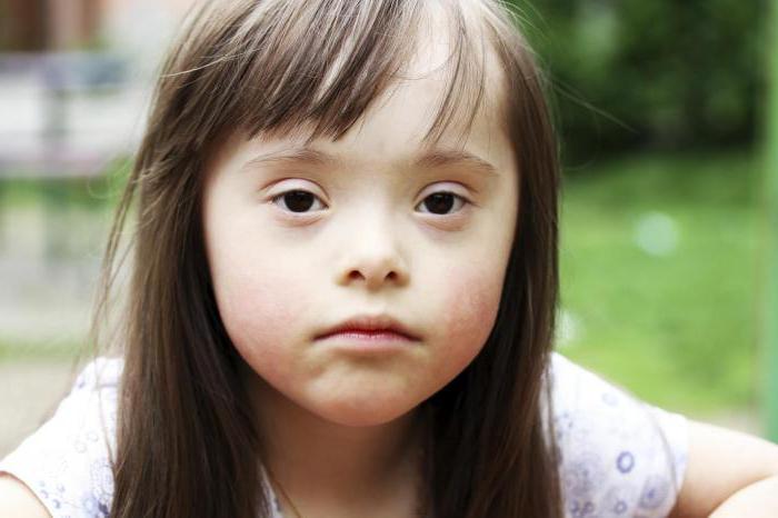 kako se djeca rađaju sa sindromom Down