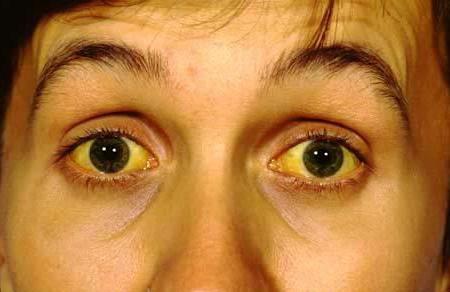 proč jsou bílé oči žluté