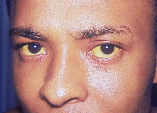 žluté oční bílé