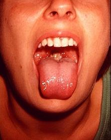 Akné na jazyku