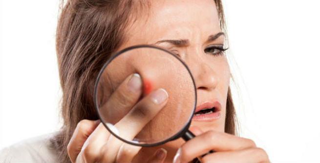 zakaj se akne pojavijo na licih