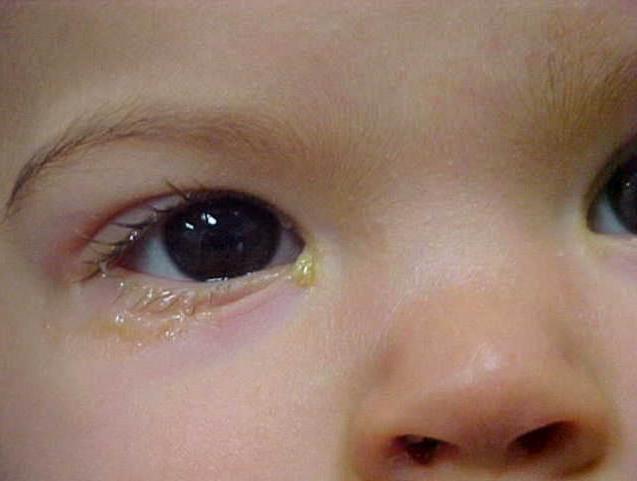 otrok ima kisle oči