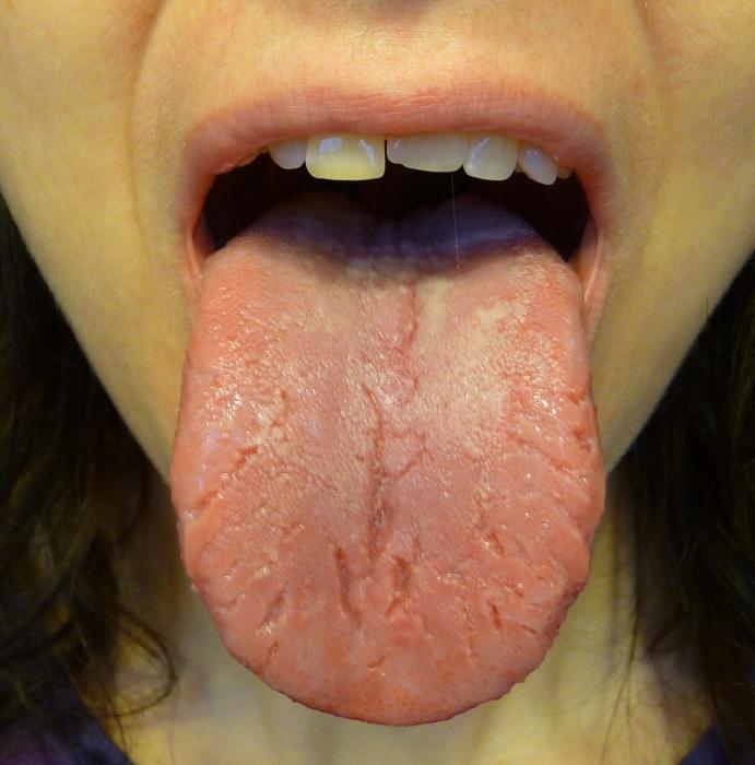 pukotine u liječenju jezika