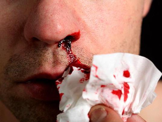izcedek iz nosu s krvjo