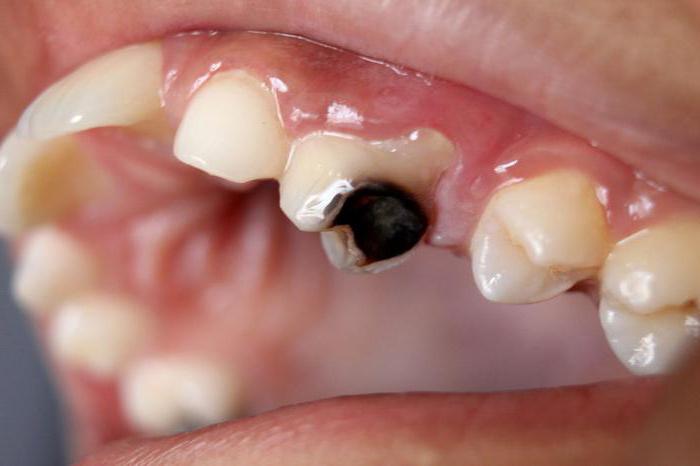 премахна нерва от зъба при натискане боли