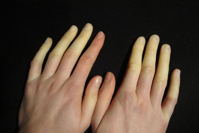 dlaczego drętwiejące palce palców wybielają