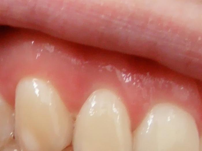 flusso dopo l'estrazione del dente