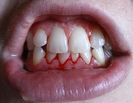co dělá dásně krvácet