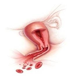 krwawienie z wczesnej ciąży