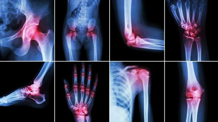 dislokacija i bol u zglobovima artroza liječenja ruku i gimnastika
