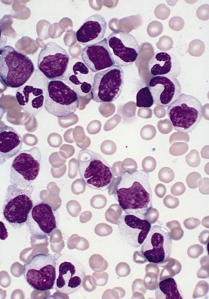 limfocyty i monocyty są podwyższone