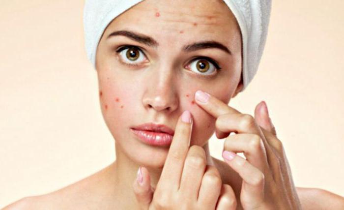 perché l'acne non può essere schiacciata