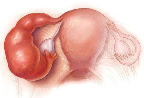 vaječník ubližuje během těhotenství