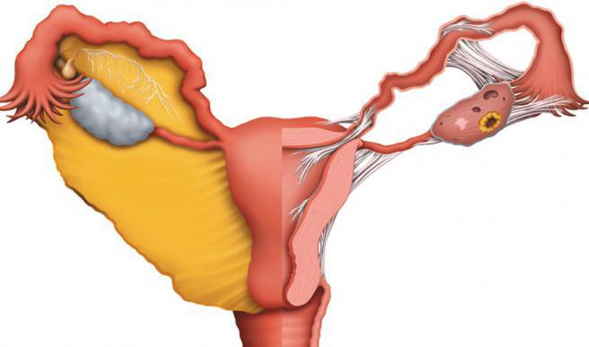 rana lijeva jajnika rano u trudnoći