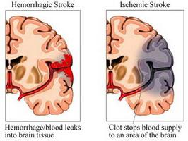 узроци крварења у мозгу