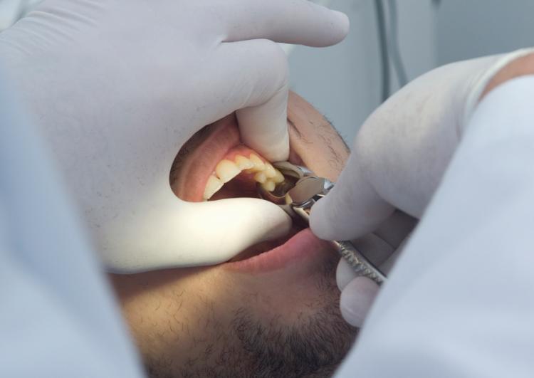 zobni karijes zdravi ali odstrani