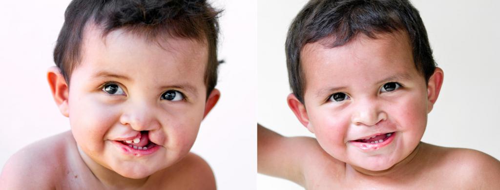 снимка преди и след операцията
