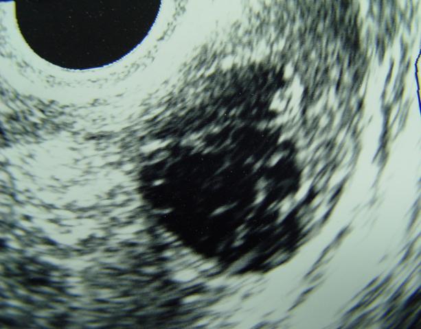 żółte ciało w jajniku na USG