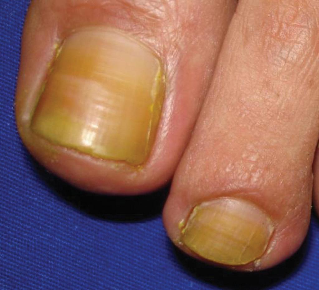 żółte paznokcie