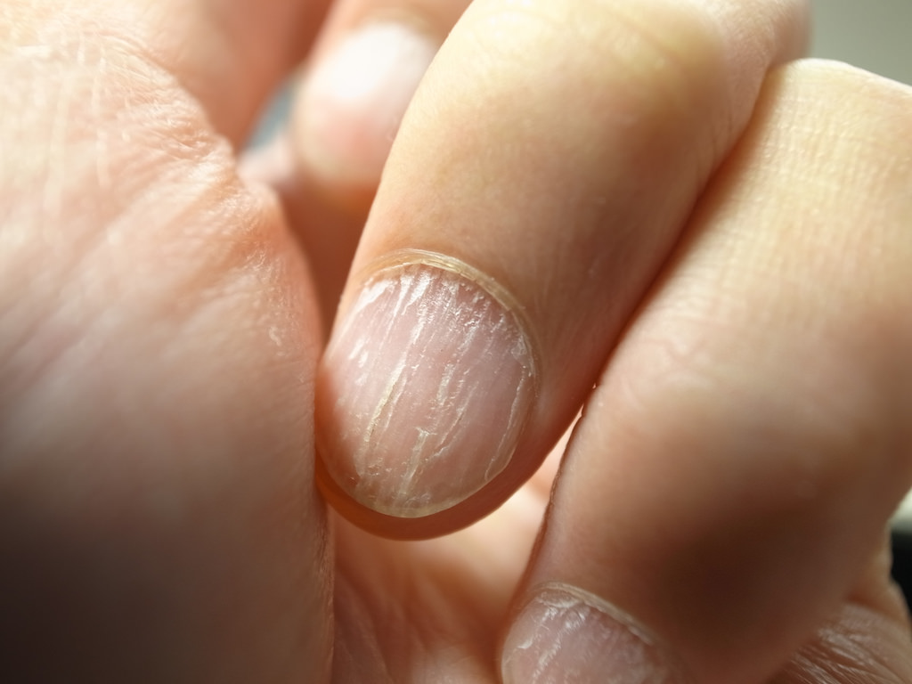 причините за ексфолиация и жълтеност на ноктите