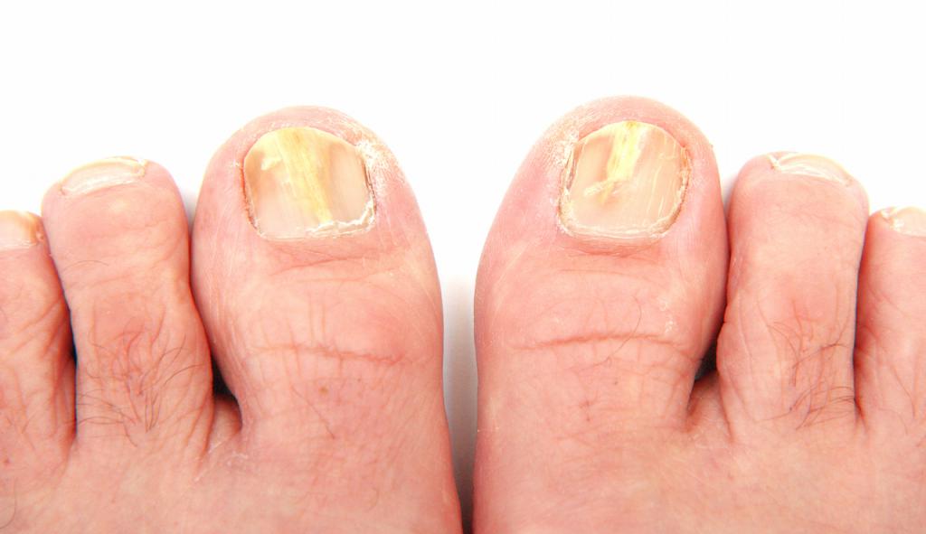 żółte paznokcie niż leczyć