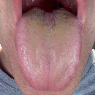 лечение с жълт език