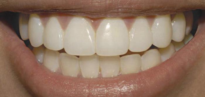 циркониеви корони на предните зъби